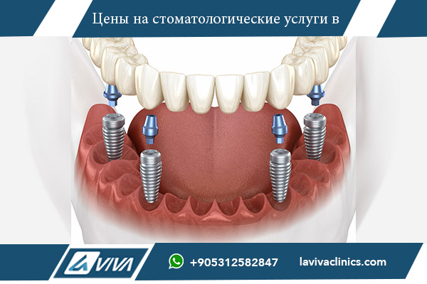 Имплантаты All-on-4 в Турции