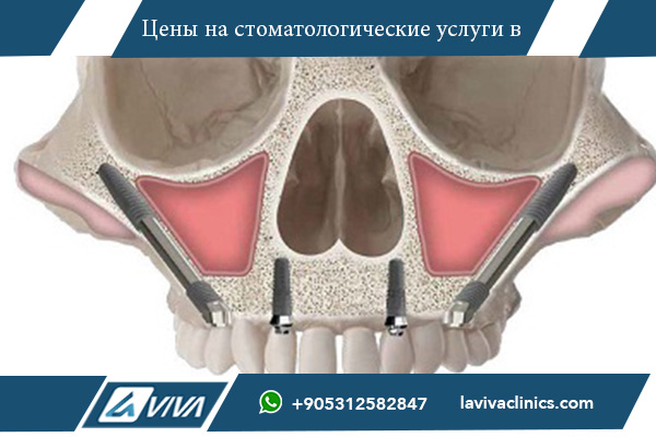 Скуловые имплантаты в Турции