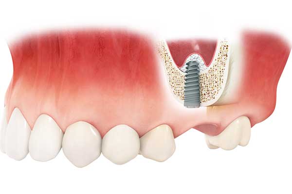 имплантация зубов без костной пластики