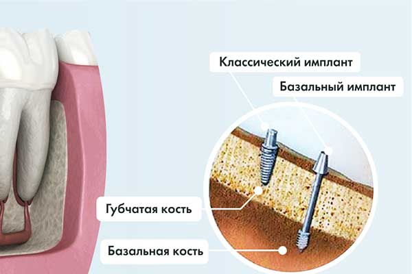 имплантация зубов в грозном цены