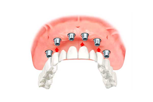 имплантация зубов все на 6