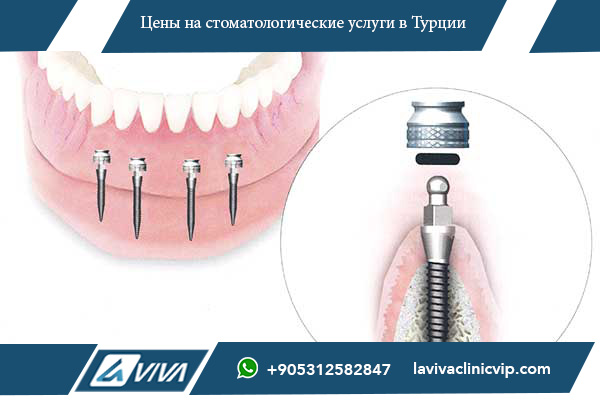 имплантацию зубов в Германии , цены на имплантацию зубов в Германии, цены на имплантацию зубов в Турции, сравнение цен на имплантацию зубов, почему выбрать Турцию для имплантации зубов, имплантация зубов в Турции преимущества, стоимость имплантации зубов в Турции и Германии, отзывы о имплантации зубов в Турции, лучшие клиники для имплантации зубов в Турции