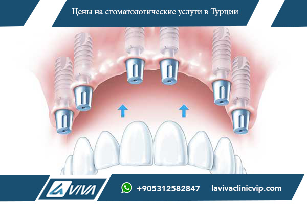 имплантацию зубов в Венгрии , сравнение цен на имплантацию зубов, имплантация зубов в Венгрии, имплантация зубов в Турции, цены на импланты в Венгрии и Турции, где дешевле имплантация зубов, почему выбрать Турцию для имплантации зубов, лучшие стоматологические клиники в Турции, медицинский туризм в Турции, стоимость зубных имплантов, зубные импланты Турция Венгрия сравнение