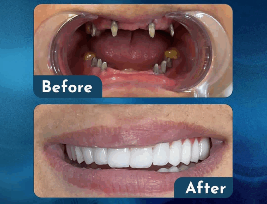 Имплантаты на весь рот в 2025 году: Полное руководство по современным методам восстановления зубов