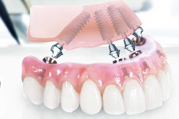 Зробити зуби в Туреччині