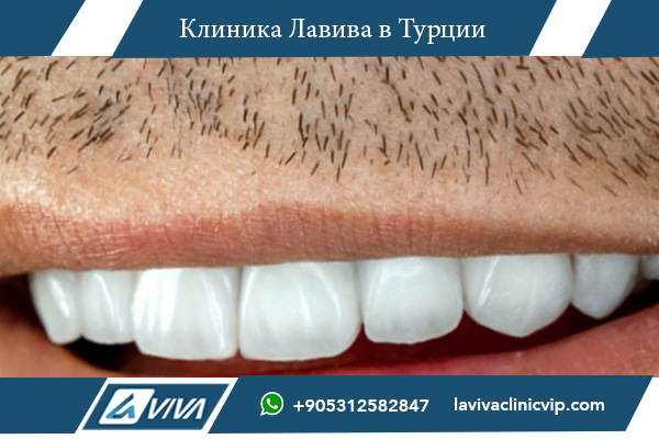 Турция или Узбекистан имплантация зубов