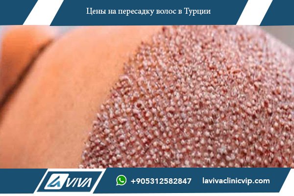 Цены на пересадку волос в Грузии