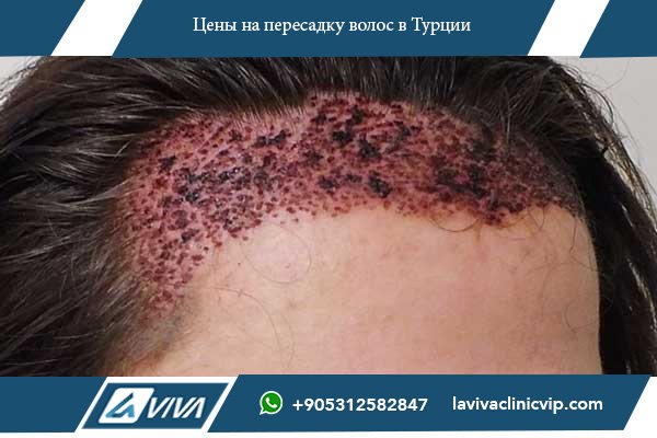 Пересадка волос в Беларуси
