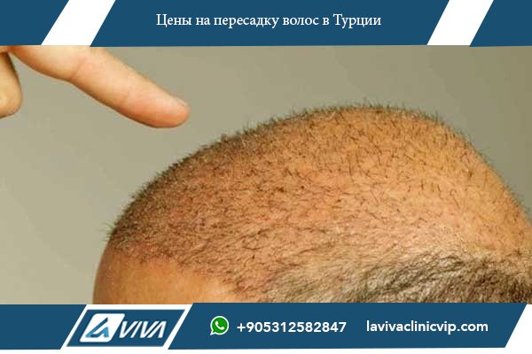 Цены на пересадку волос в Узбекистане