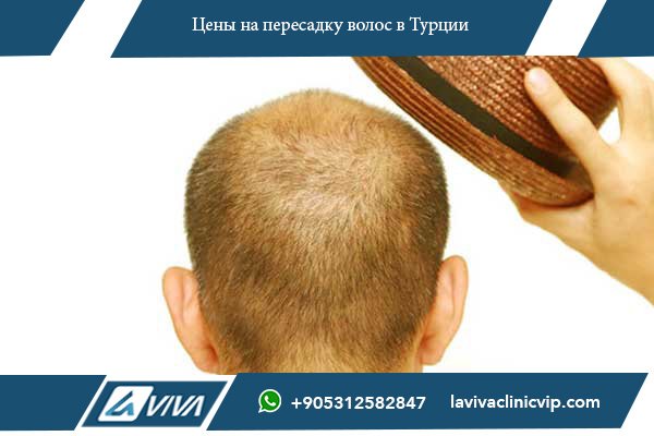 Пересадка волос в Украине