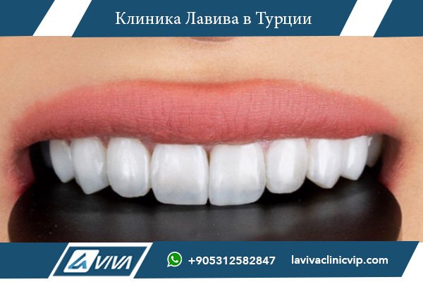 Самые безопасные и надежные зубные импланты: Критерии выбора